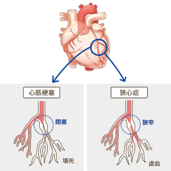 心筋梗塞、狭心症のイメージ図