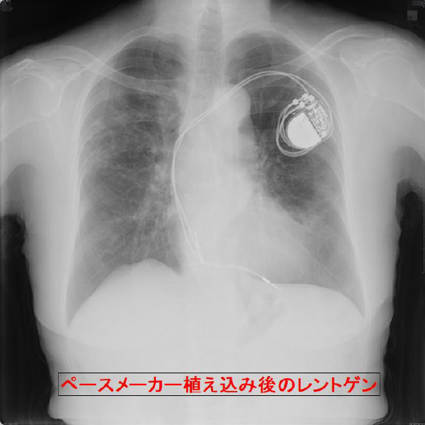ペースメーカー植え込み後のレントゲン画像