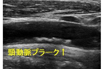 頸動脈プラークのエコー画像