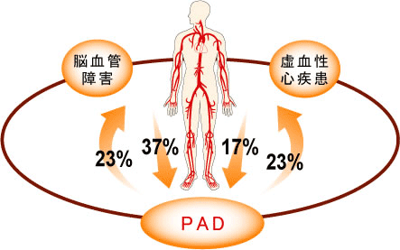 PAD(末梢動脈疾患)図
