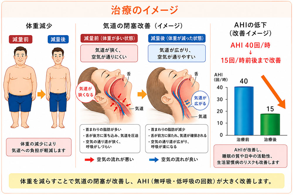 減量治療のイメージ画像