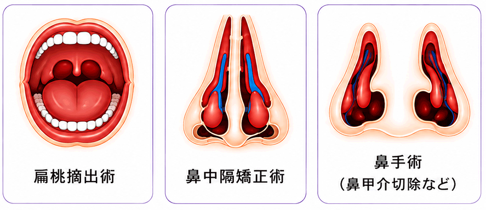 ➄外科的治療(耳鼻科手術)